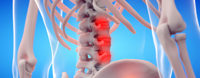 patient needing ankylosing spondylitis treatment in Orange