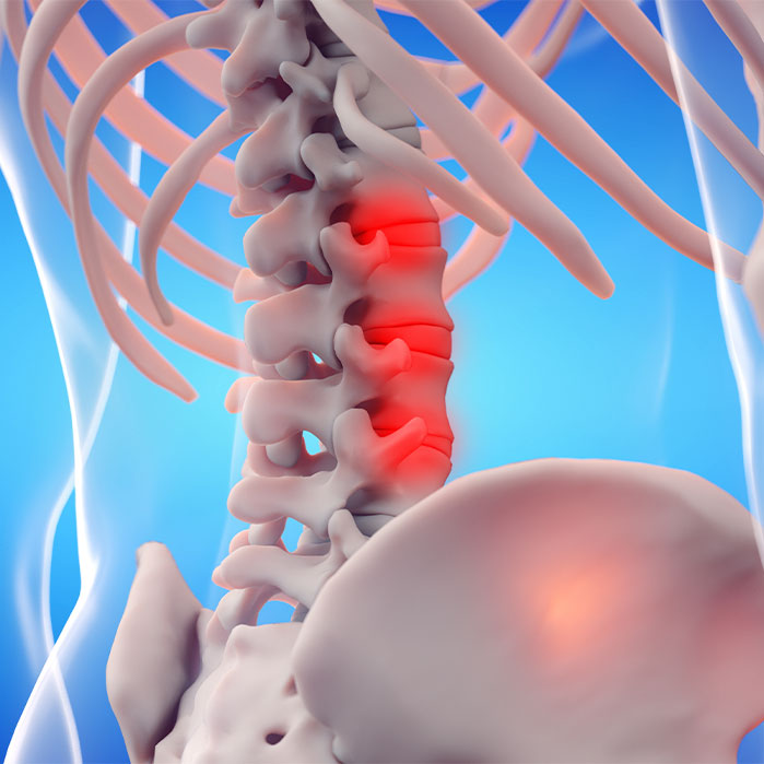 ankylosing spondylitis chiropractor in Orange, CA