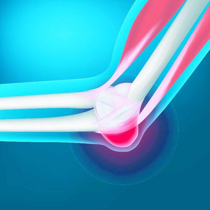 bursitis chiropractor in Orange, CA