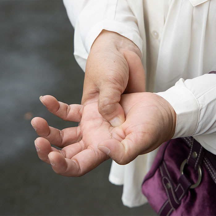 dupuytren contracture chiropractor in Orange, CA