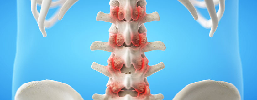 patient needing facet joint syndrome treatment in Orange