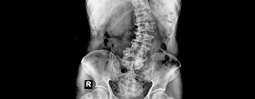 patient needing scoliosis treatment in Orange