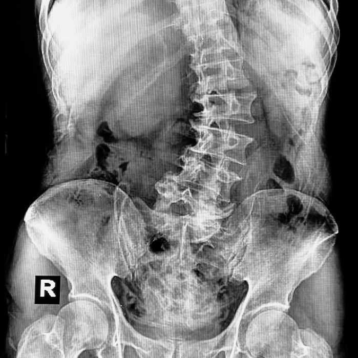 scoliosis chiropractor in Orange, CA
