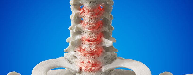patient needing spondylosis treatment in Orange