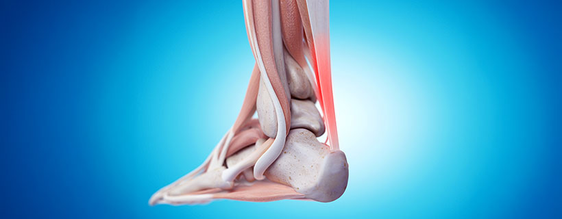 patient needing tendonitis treatment in Orange