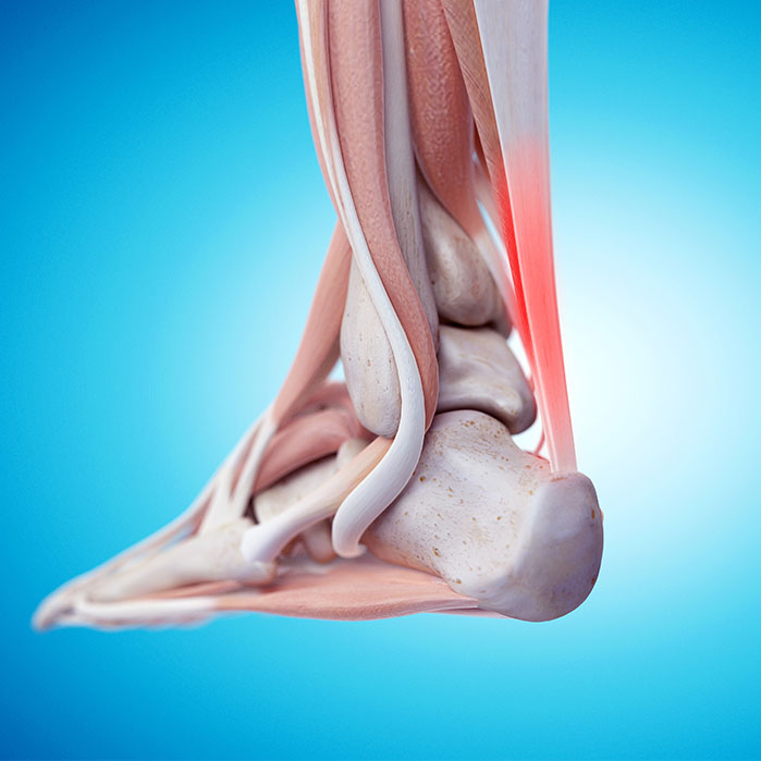 tendonitis chiropractor in Orange, CA
